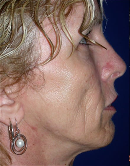 Forehead-type-2-brow-lift-facelift-04-after